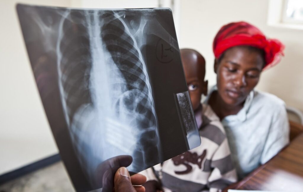 Abarwayi b’Igituntu bagabanyutseho 42% mu Rwanda