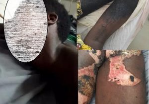 Rwamagana: Umukozi wo mu rugo yatwitswe na nyirabuja n’amazi yatuye