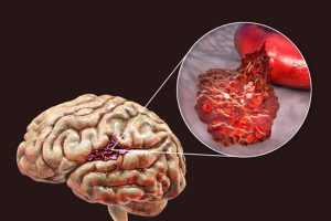 Sobanukirwa indwara ya stroke n’uko yakwirindwa