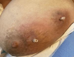 Menya indwara itera ububabare bw’amabere yitwa Mistitis