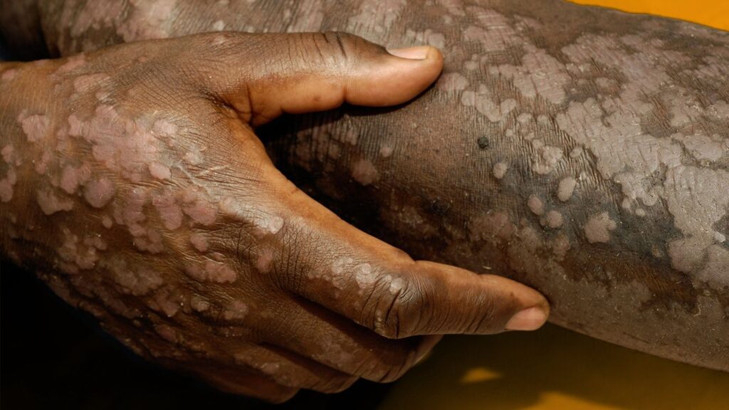 Indwara ya Psoriasis ntiyandura ntibikwiye guha akato abayirwaye