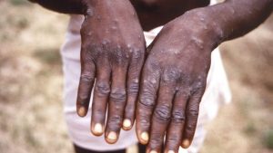 RBC irashishikariza abantu kwihutira kwa muganga mu gihe bagaragaje ibimenyetso