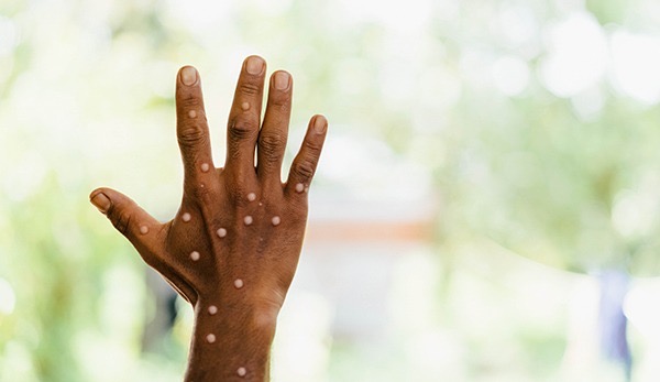 Inkomoko y’icyorezo cya Mpox (Ubushita bw’Inkende)
