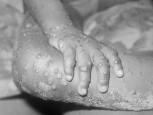Mu Karere ka Rubavu hakajijwe ingamba zo gukumira icyorezo cya Mpox