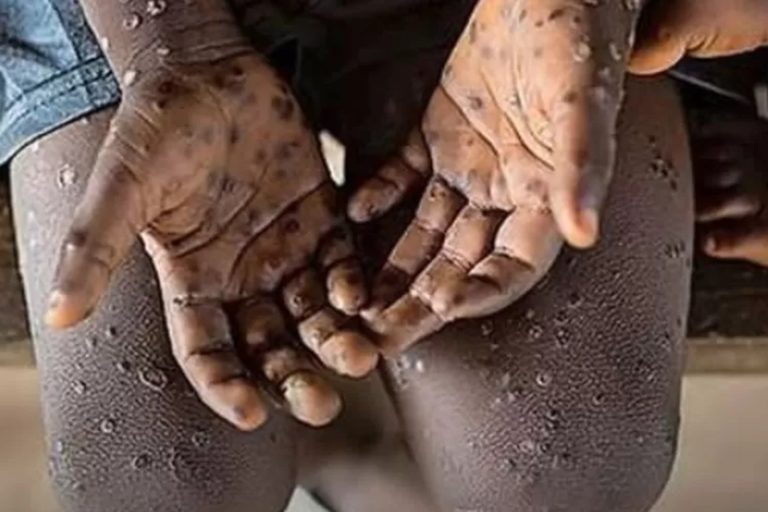 Mu Rwanda, abagaragayeho Mpox bose barakize