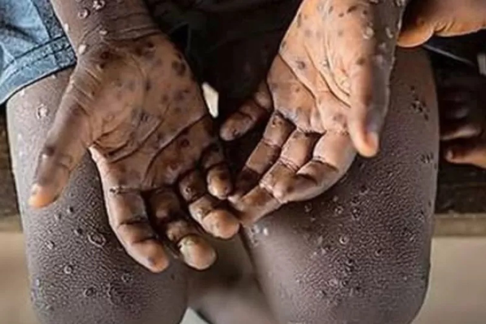 Mu Rwanda, abagaragayeho Mpox bose barakize