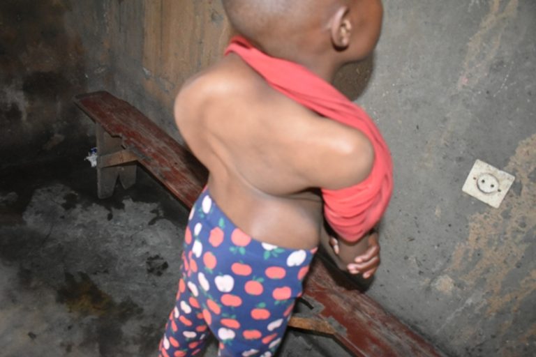 Burera: Arasabwa miliyoni 15 Frw yo kuvuza umwana ufite urutirigongo rwahetamye