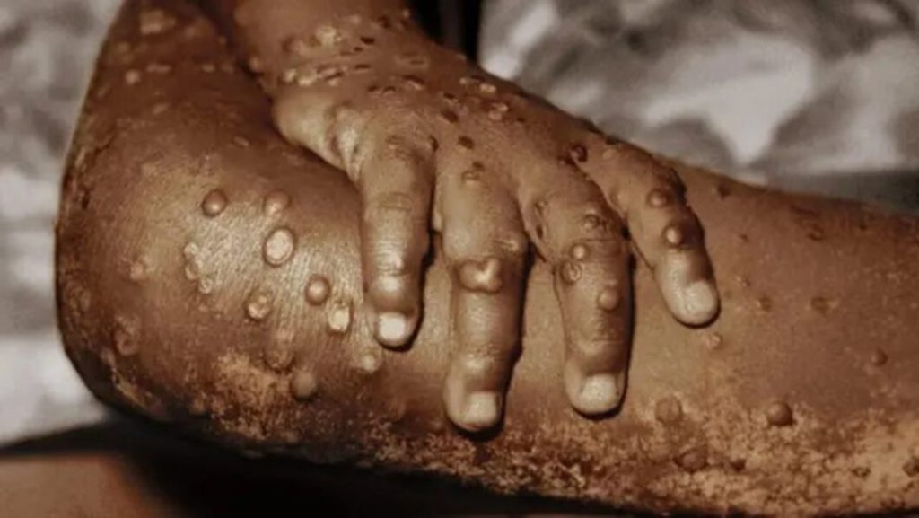 Abanduye Mpox muri Afurika bageze ku 35 000
