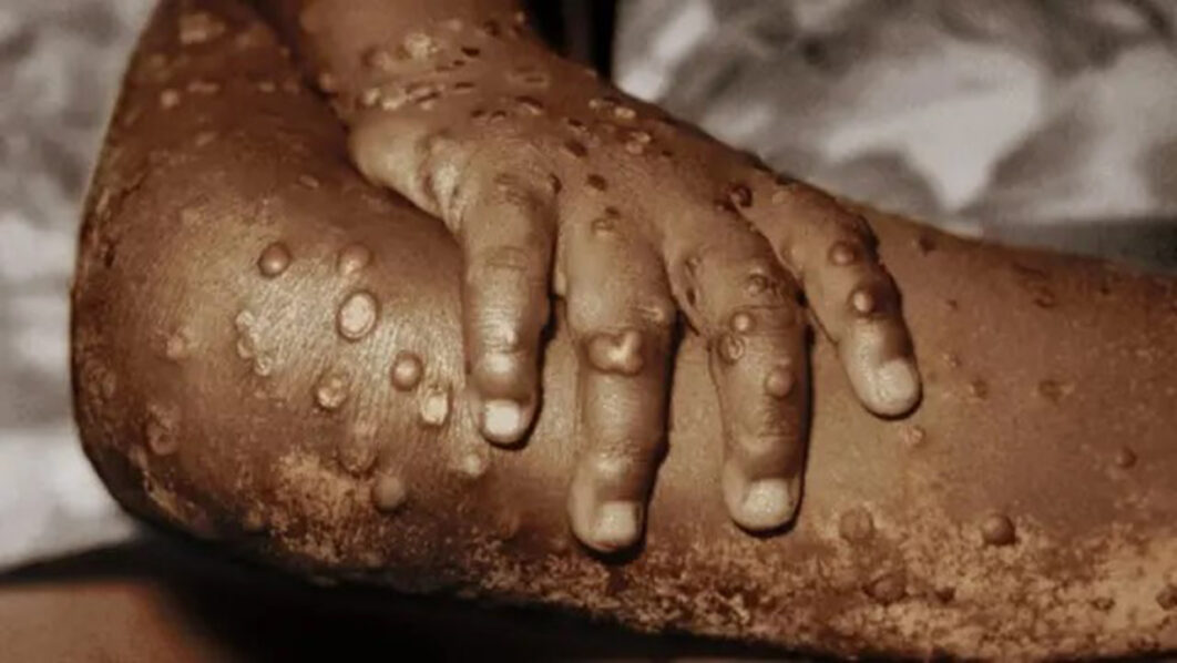 Abanduye Mpox muri Afurika bageze ku 35 000