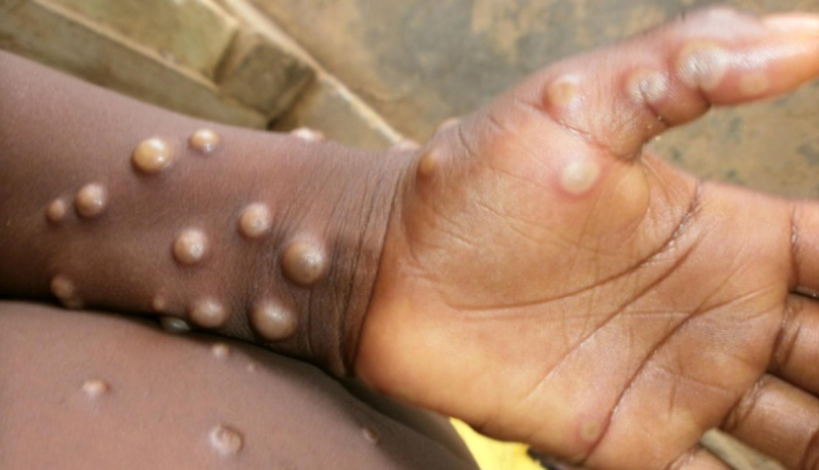 Abantu bane cyangwa batanu bandura Indwara ya Mpox mu Rwanda buri cyumweru- RBC