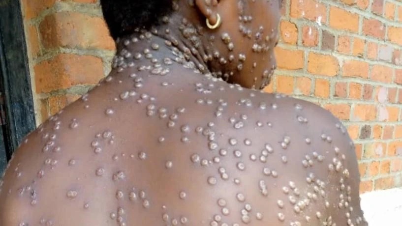 Sierra Leone: Yemeje ko habonetse abanduye ubushita bw’inkende