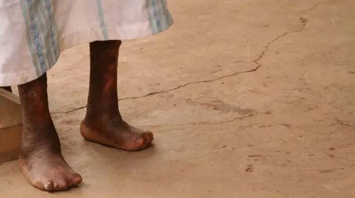 Bugesera: Barwaye ibibembe babyitiranya n’amadayimoni na karande