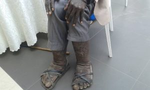 Abantu 1311 bakize indwara y’imidido mu Rwanda
