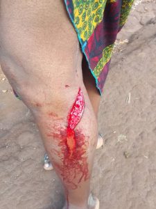 Rusizi: Umugore ararembye nyuma yo kurumwa n’ingurube nyirayo yari ashoreye