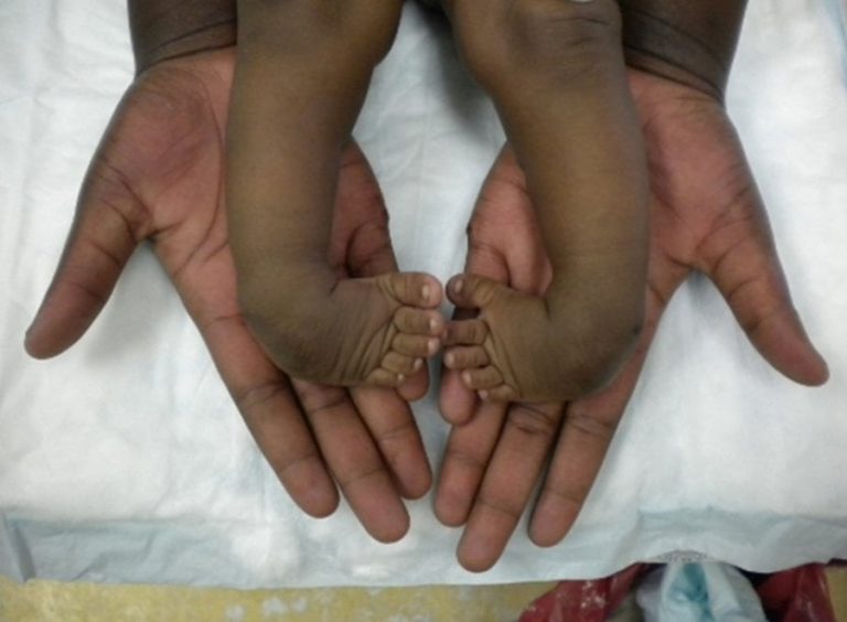 Uburwayi bw’ingingo buzwi nka ‘Clubfoot’ buravurwa bugakira